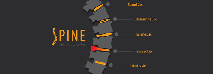 Chiropractic Fort Worth TX Bulging Discs